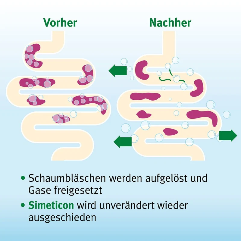 Espumisan Gold Perlen gegen Blähungen (Medizinprodukt), 20 St. Kapseln