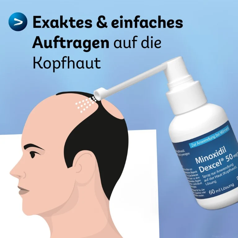 Minoxidil Dexcel 50 mg/ml Spray für Männer zur Anwendung auf der Haut (Kopfhaut), 60 ml Lösung